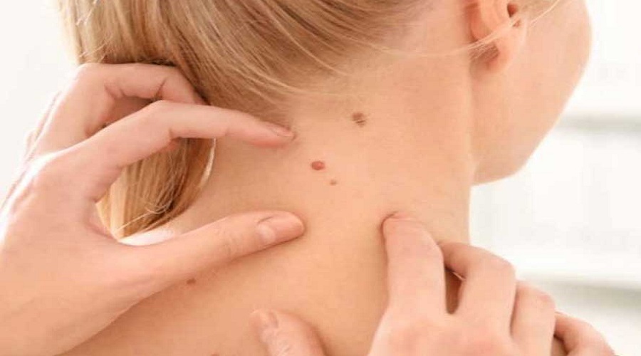 خال سرطانی؛ علائم خال های سرطانی، تشخیص و انواع روش های درمان
