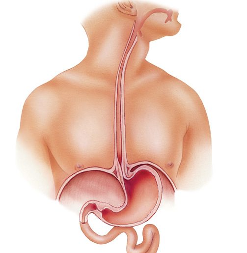 سوزش معده؛ علایم، دلایل و درمان سوزه معده