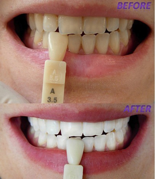 سفید کردن دندان؛ روش های سفید کردن دندان، ساده ترین روش سفید کردن دندان در منزل سفید کردن دندان؛ روش های سفید کردن دندان، ساده ترین روش سفید کردن دندان در منزل