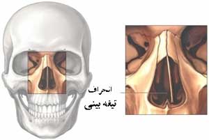 سخت شدن تنفس به دلیل انحراف تیغه بینی؛ انحراف تیغه بینی چیست؟