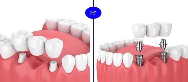 بریج بهتر است یا ایمپلنت ؟