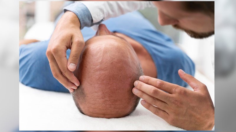 آیا جایگزین کاشت مو وجود دارد؟ + انواع روش ها