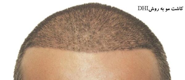 مدرن ترین روش های کاشت مو برای داشتن موهای پرپشت و زیبا مدرن ترین روش های کاشت مو برای داشتن موهای پرپشت و زیبا