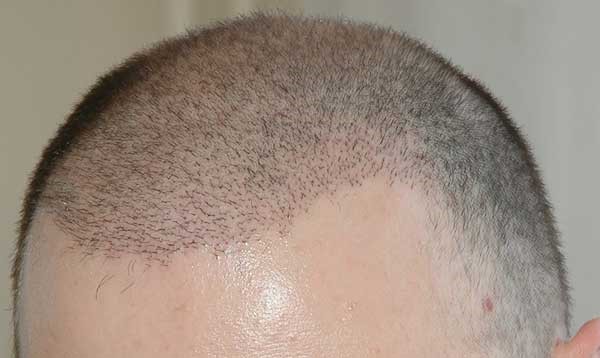 مدرن ترین روش های کاشت مو برای داشتن موهای پرپشت و زیبا مدرن ترین روش های کاشت مو برای داشتن موهای پرپشت و زیبا