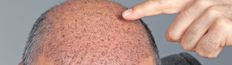 کاشت مو؛ عوارض کاشت مو، مراقبت های بعد از کاشت مو، همه چیز درباره کاشت مو