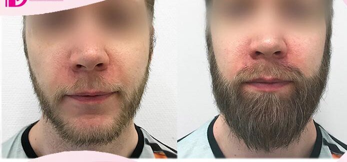 کاشت ریش و سبیل | اطلاعات در مورد کاشت، روش ها و هزینه های آن