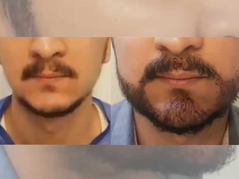 کاشت ریش و سبیل | اطلاعات در مورد کاشت، روش ها و هزینه های آن