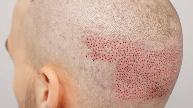 کاشت مو به روش FIT ، اطلاعات کامل در مورد این روش، مزایا و معایب