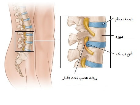 علائم و عوارض دیسک کمر + روش های نوین درمان با جراحی و بدون جراحی