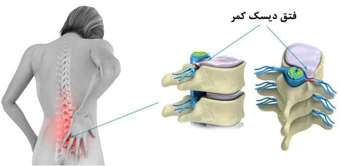 علائم و عوارض دیسک کمر + روش های نوین درمان با جراحی و بدون جراحی