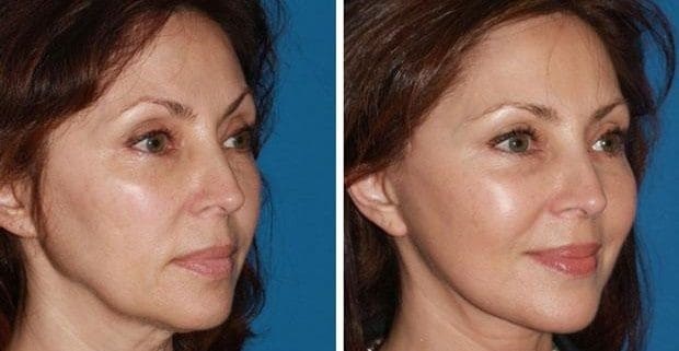 لیفت گونه چیست؟ انواع روش های لیفت گونه برای زیباسازی صورت