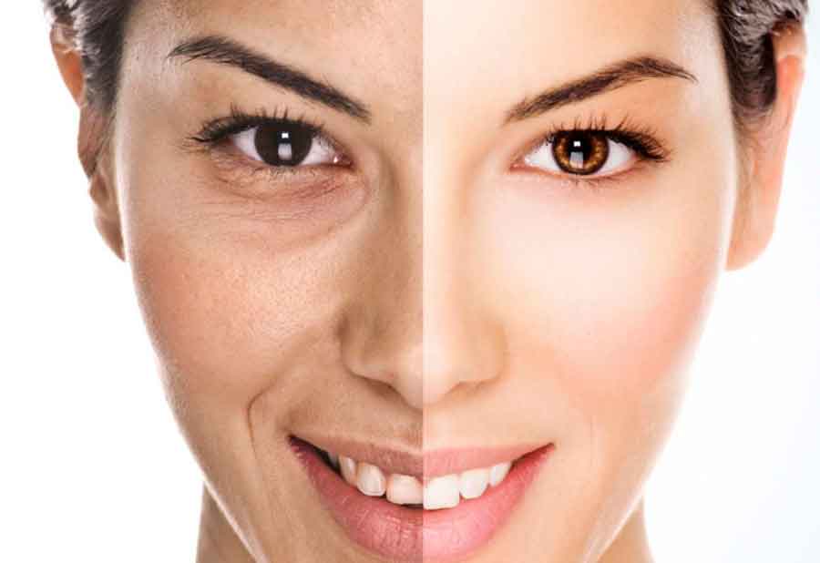 کربوکسی تراپی چیست؟ کاربردهای این روش، مزایا و عوارضی که دارد