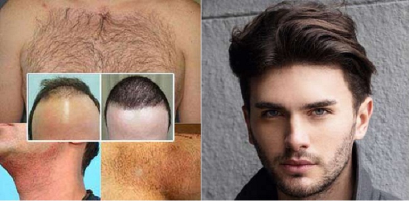 کاشت مو با روش BHT + مراحل انجام آن و مزایای و معایبی که دارد