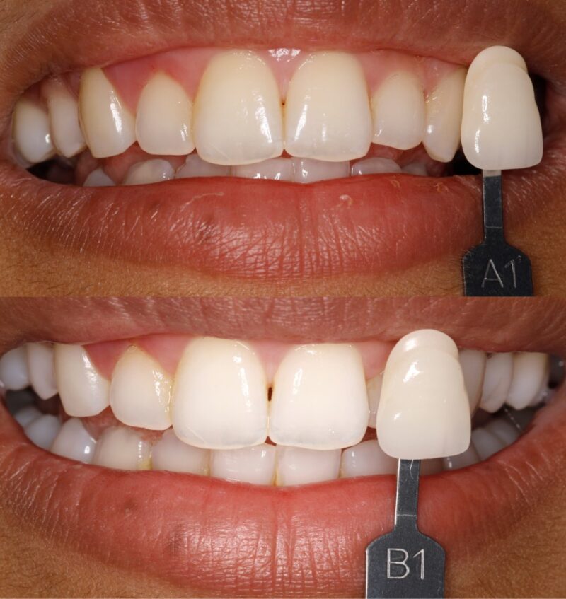 بلیچینگ دندان (سفید کردن دندان ها) و مزایا و معایبی که دارد
