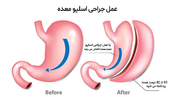 عمل اسلیو معده | افراد مناسب برای این عمل