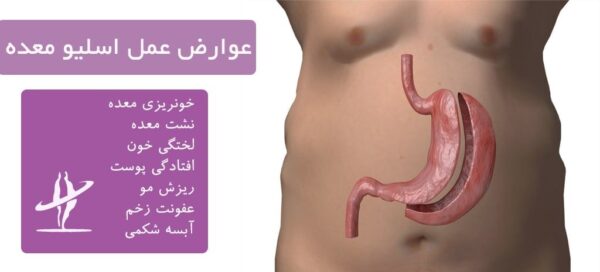 عمل اسلیو معده | افراد مناسب برای این عمل