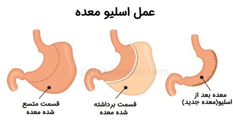 عمل اسلیو معده | افراد مناسب برای این عمل