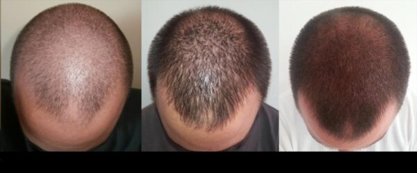 فیناستراید Finasteride برای درمان ریزش مو + نحوه مصرف و عوارض آن