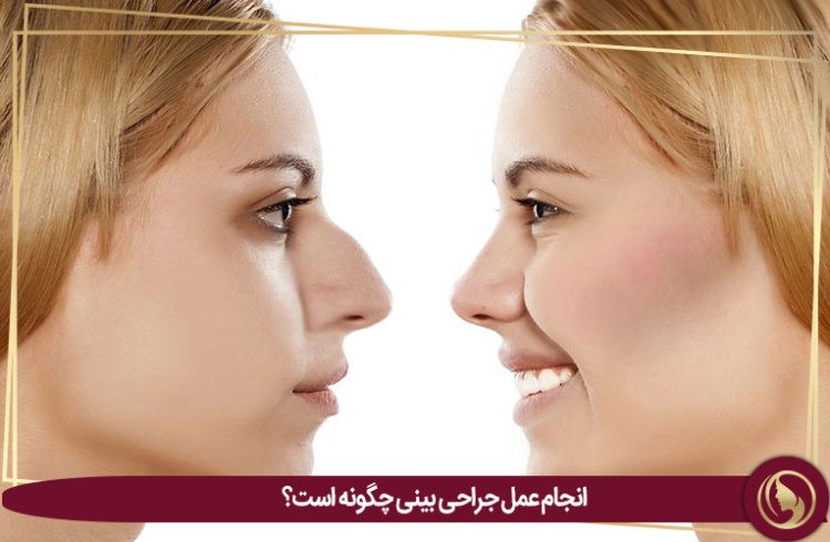رینوپلاستی یا عمل زیبایی بینی و دلایل انجام و مراقبت های پس از عمل