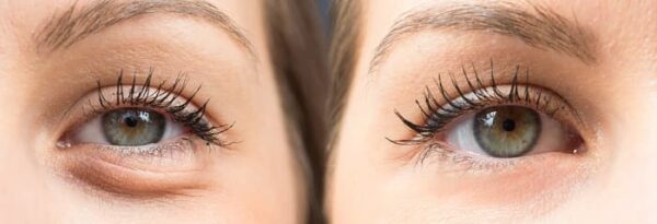 دلایل ایجاد پف زیر چشم و روش های درمان به صورت طبیعی دلایل ایجاد پف زیر چشم و روش های درمان به صورت طبیعی