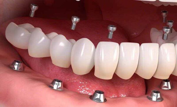 ایمپلنت فوری چیست؟ روش های انجام آن و مزایای و معایب این روش