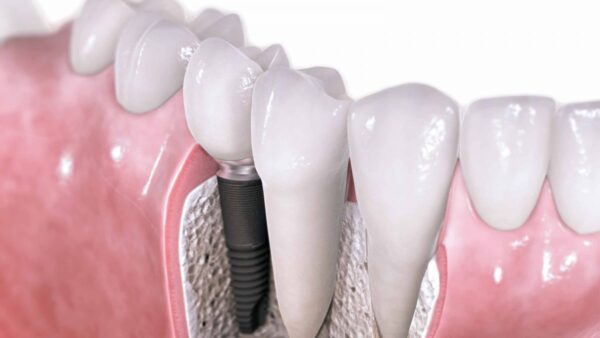 ایمپلنت فوری چیست؟ روش های انجام آن و مزایای و معایب این روش