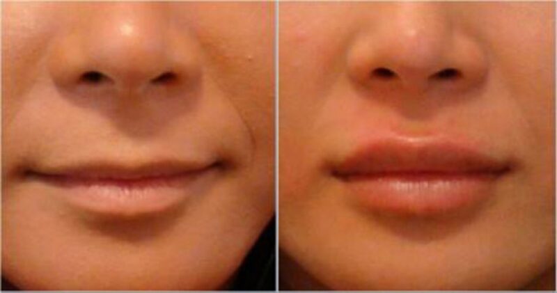 تزریق ژل دائمی برای زیبایی