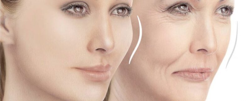 تزریق ژل دائمی برای زیبایی