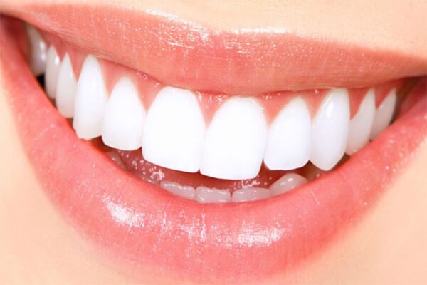 لمینت دندان چیست چگونه انجام می شود و چه مزایای و معایبی دارد؟