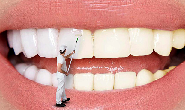 لمینت دندان چیست چگونه انجام می شود و چه مزایای و معایبی دارد؟