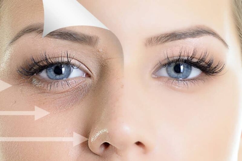 تزریق فیلر زیر چشم چیست؟ هدف، مراحل، شرایط و مزایای انجام این روش