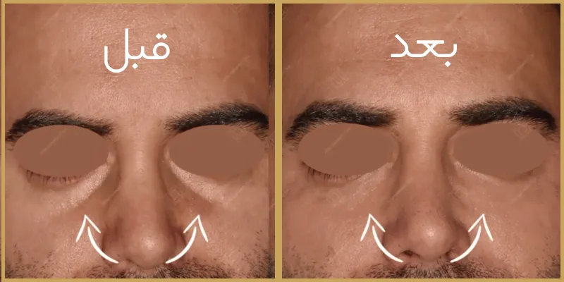 تزریق فیلر زیر چشم چیست؟ هدف، مراحل، شرایط و مزایای انجام این روش