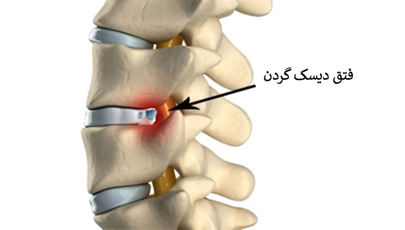 علائم دیسک گردن چیست و چگونه درمان می شود؟