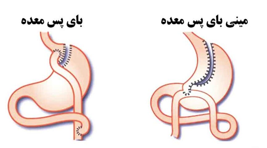 جراحی بای پس معده چگونه انجام می شود و چه مزایا و معایبی دارد