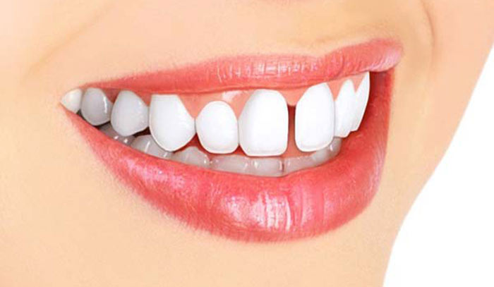 دلیل ایجاد فاصله بین دندان و چطور بسته می شود؟