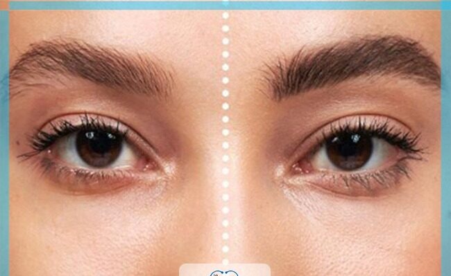 اطلاعات درباره کاشت ابرو طبیعی (عوارض، مراقبت ها و ماندگاری این روش)