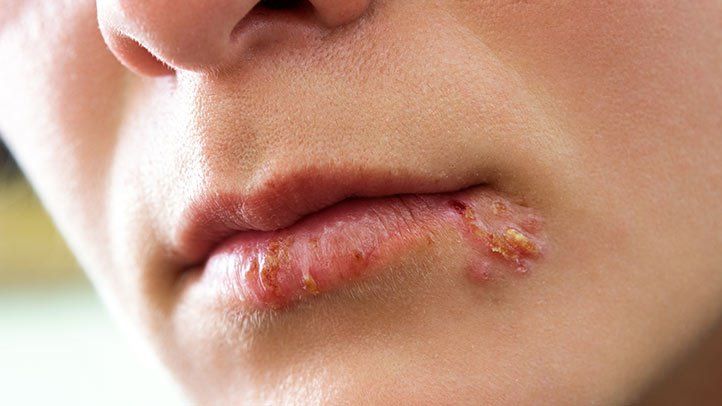 دلایل ایجاد تبخال لب | آیا واگیر دار است؟