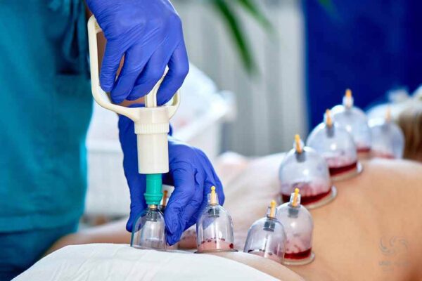 حجامت چگونه انجام می شود؟ انواع روش ها، عوارض و فواید آن