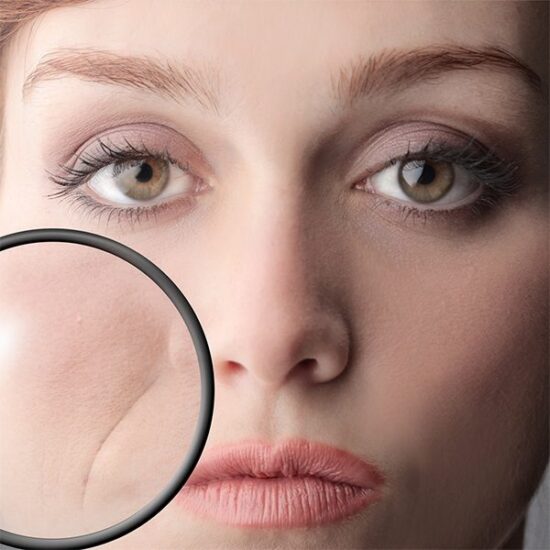 رفع خط لبخند (اصلاح خط لبخند) و روش های از بین بردن این چروک صورت رفع خط لبخند (اصلاح خط لبخند) و روش های از بین بردن این چروک صورت