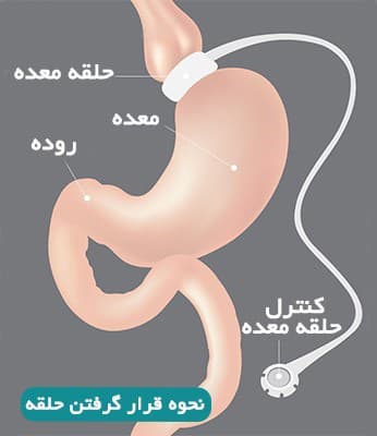 اطلاعات درباره جراحی حلقه معده به منظور کاهش وزن