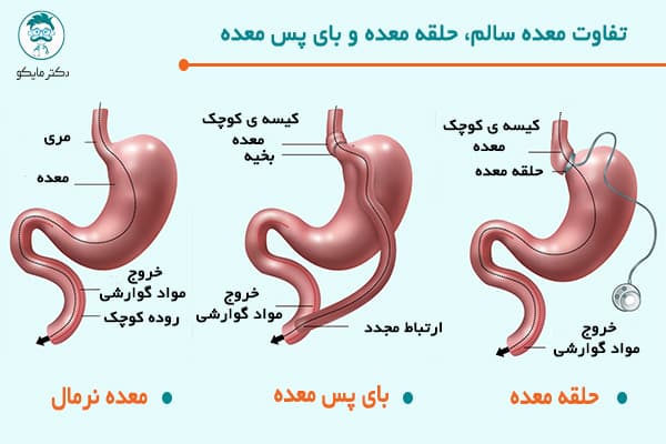 اطلاعات درباره جراحی حلقه معده به منظور کاهش وزن