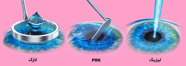عمل لازک چشم چه مزایای و عوارضی دارد و چگونه انجام می شود؟