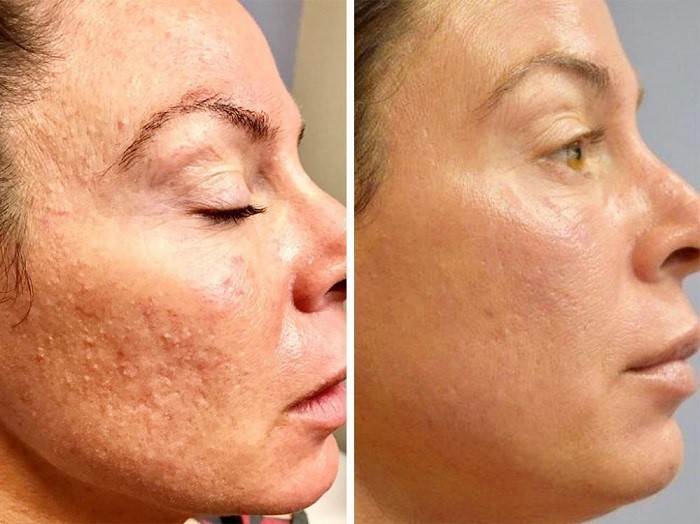 میکرونیدلینگ چیست و چه فوایدی برای پوست دارد؟ نکات خاص و معایب آن