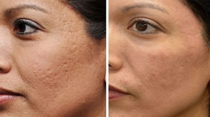 میکرونیدلینگ چیست و چه فوایدی برای پوست دارد؟ نکات خاص و معایب آن
