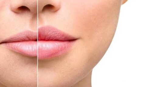 اطلاعات کامل درباره تزریق ژل لب، مزایای آن، مراقبت ها و روش های انجام