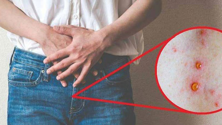 بیماری سیفلیس چیست چه علائمی دارد؟ (پیشگیری و درمان این بیماری)