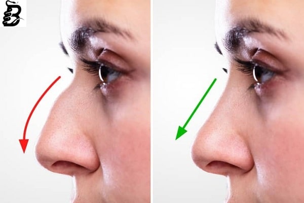 لیفت بینی + انواع روش های لیفت بینی با نخ و تزریق و بدون جراحی