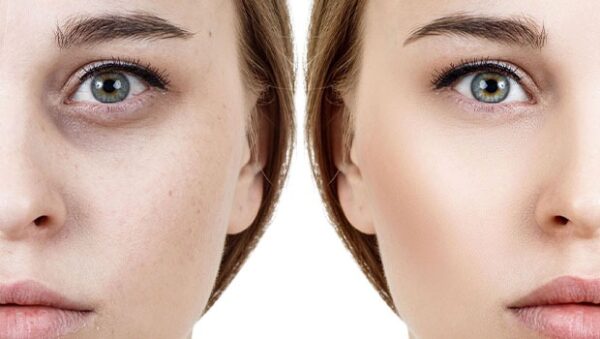 دلایل تیرگی دور و زیر چشم + روش های درمان ویژه و طبیعی آن