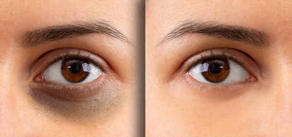 دلایل تیرگی دور و زیر چشم + روش های درمان ویژه و طبیعی آن