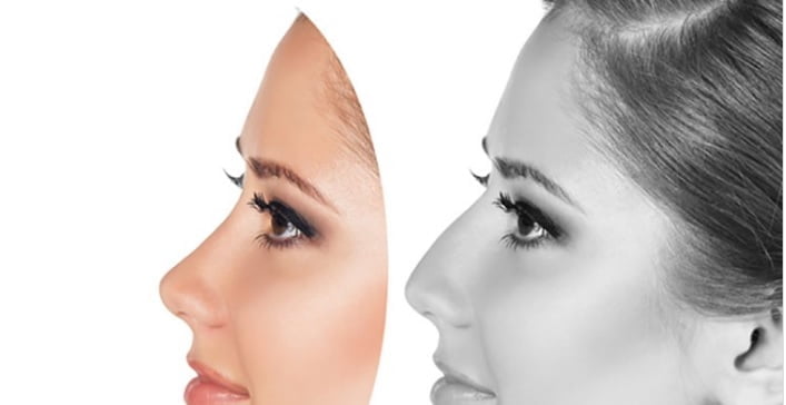 صفر تا صد جراحی بینی؛ عمل بینی و نکاتی در مورد آن